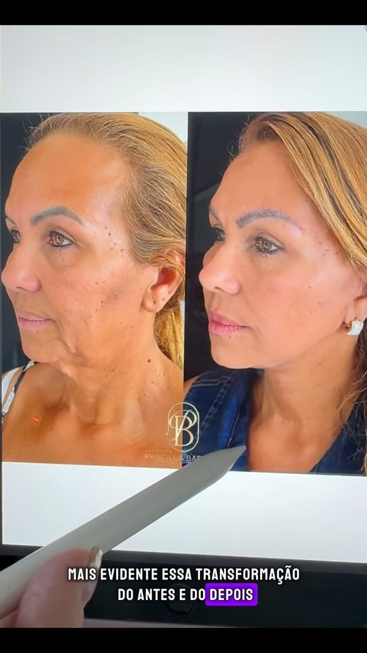 Rejuvenescimento