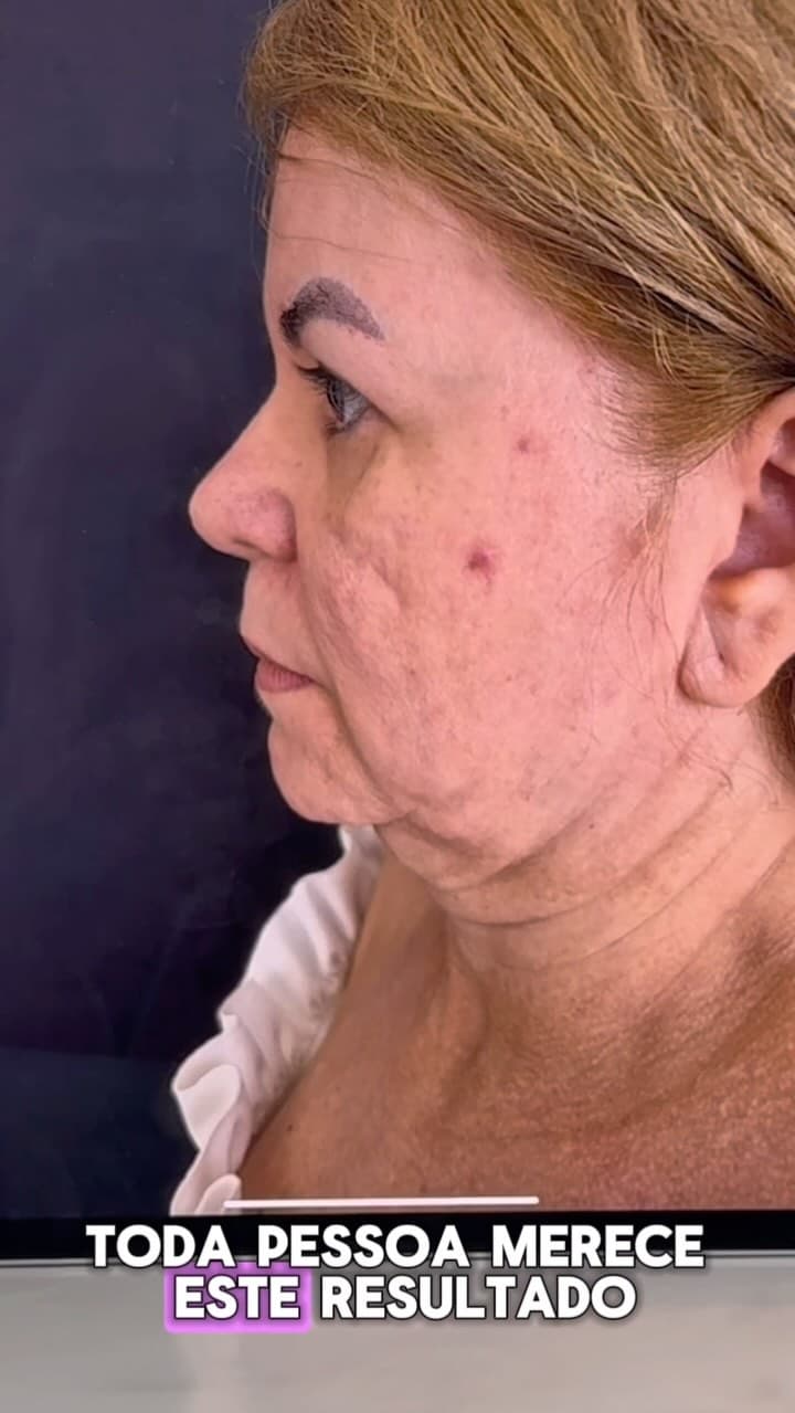 Platismoplastia Avançada — antes
